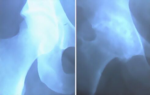 Мрачный остеоартрит коленного сустава